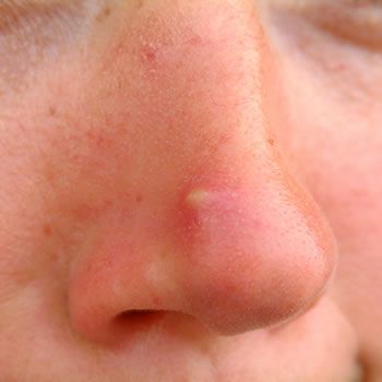 pimples nose
